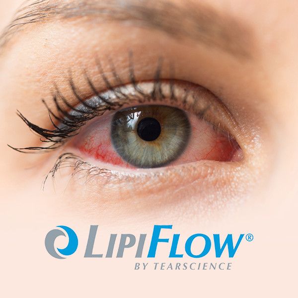 lipiflow for dry eye