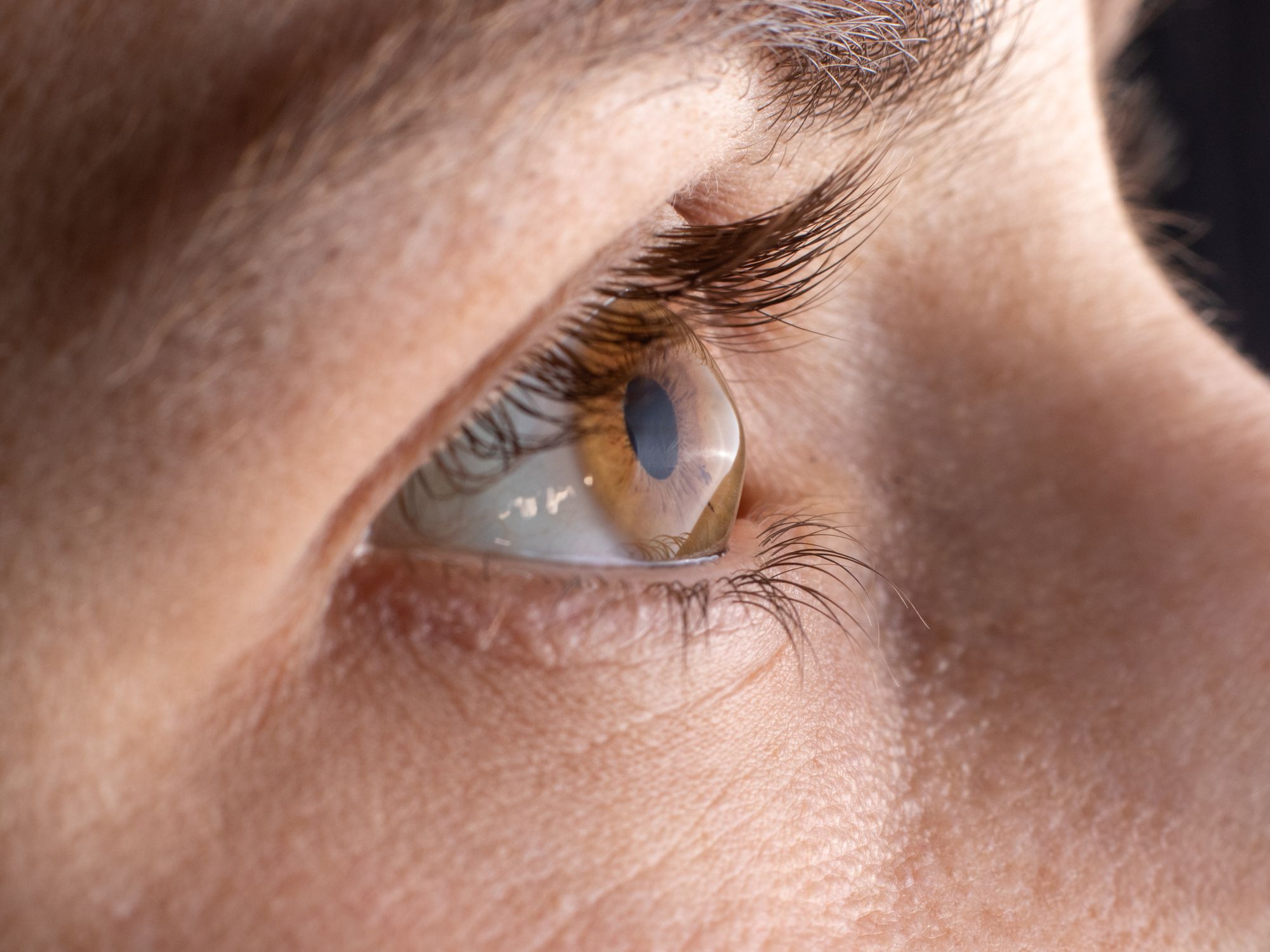 What Is Keratoconus: Signs and Symptoms