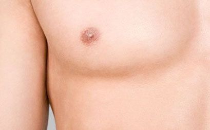 male breast reduction