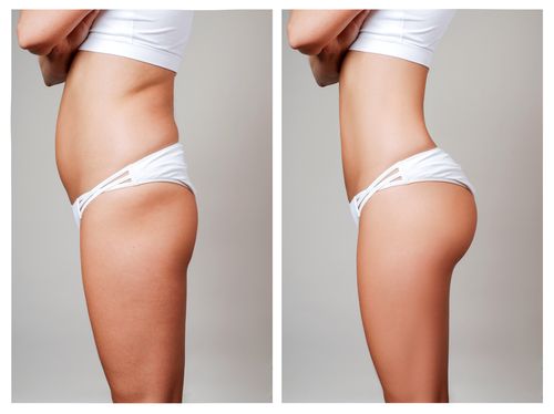 Liposuction Nyc