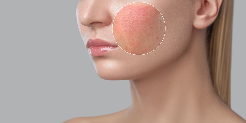 What Skin Issues Benefit From Phoenix CO2 Laser Treatments?