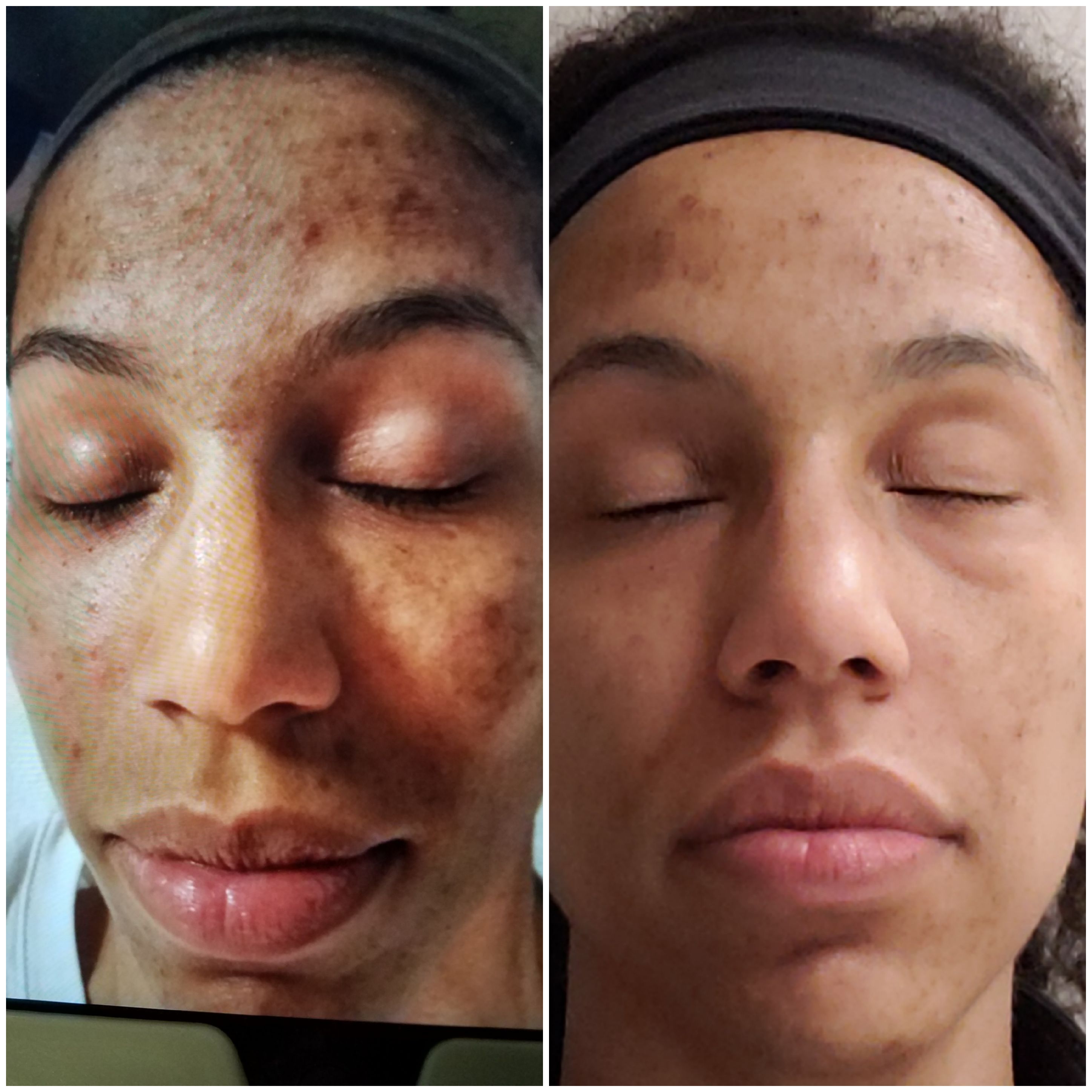 laser facial near me