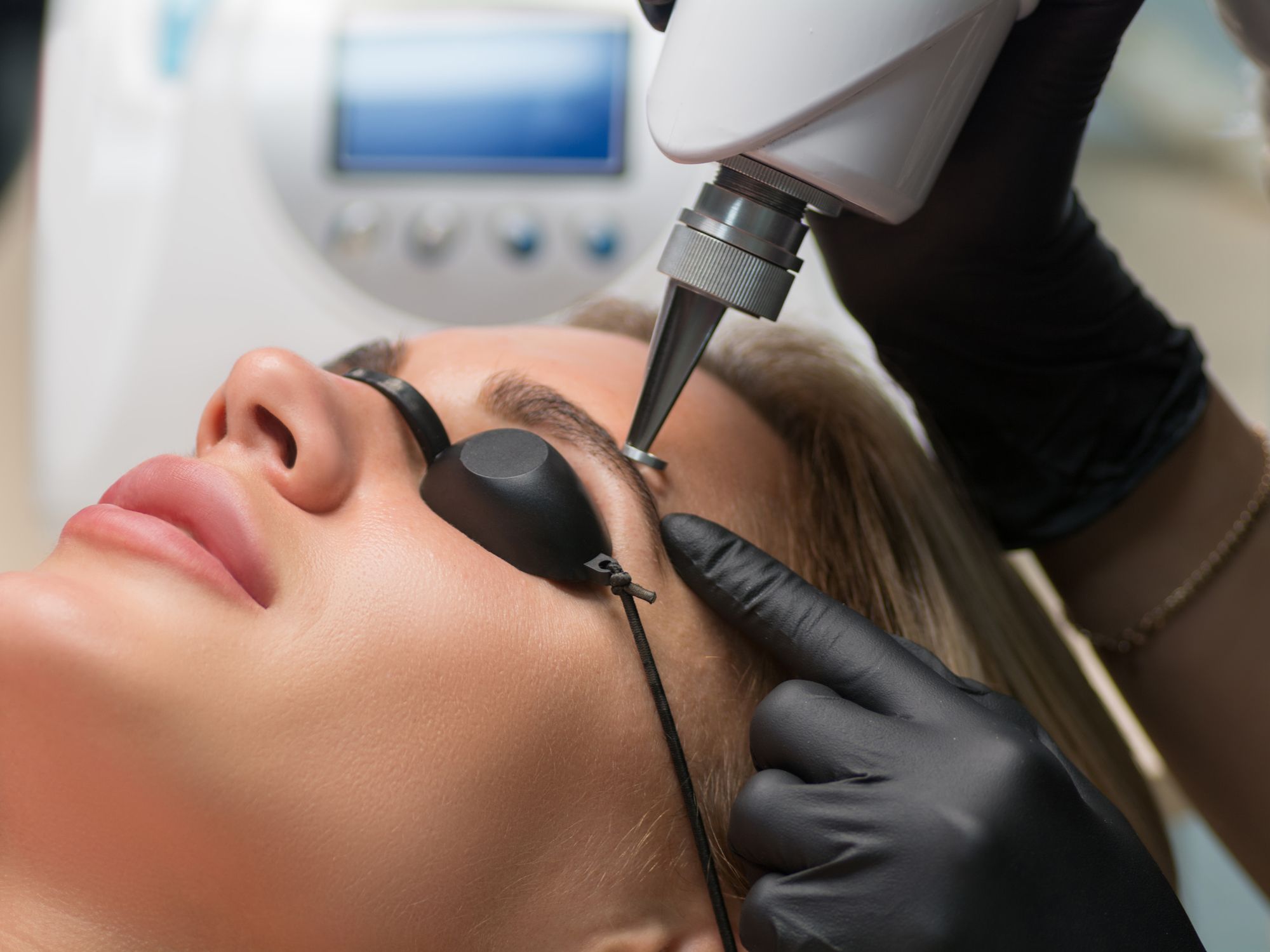 Facial Tattoo Removal: What You Need to Know