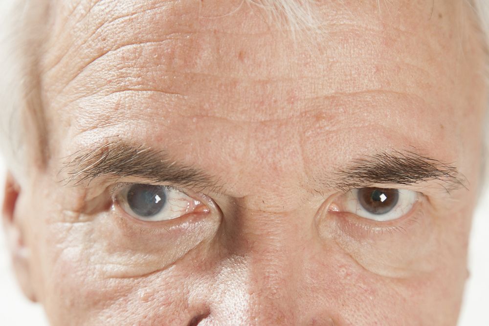 man with cataracts