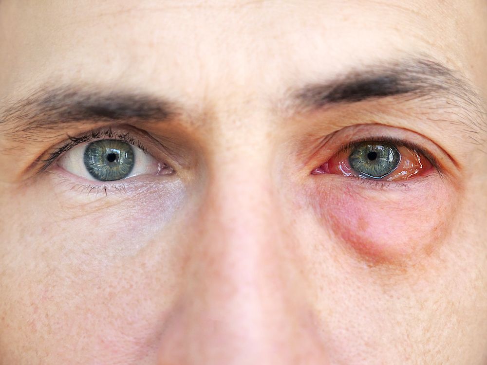 Common Eye Emergencies and How to Respond