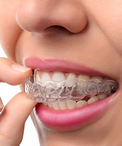 Traditional Braces vs Invisalign