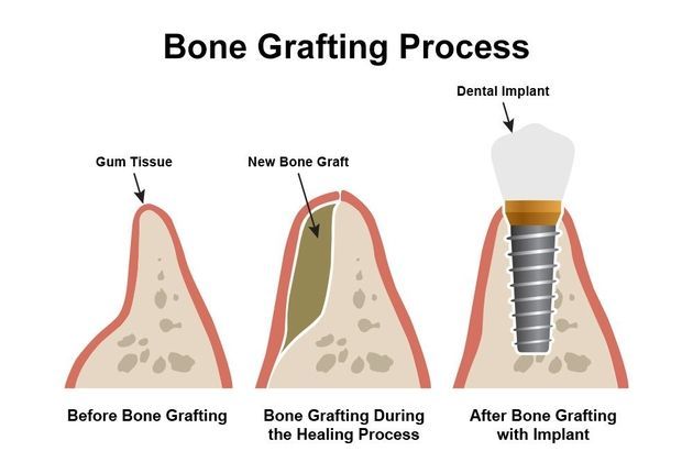 bone grafting process