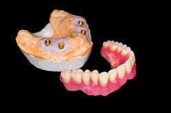 implant supported dentures