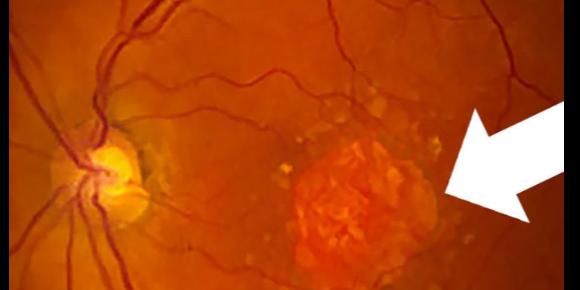 Dietary nutrient intake and progression to late age-related macular degeneration in the Age-Related Eye Disease Study