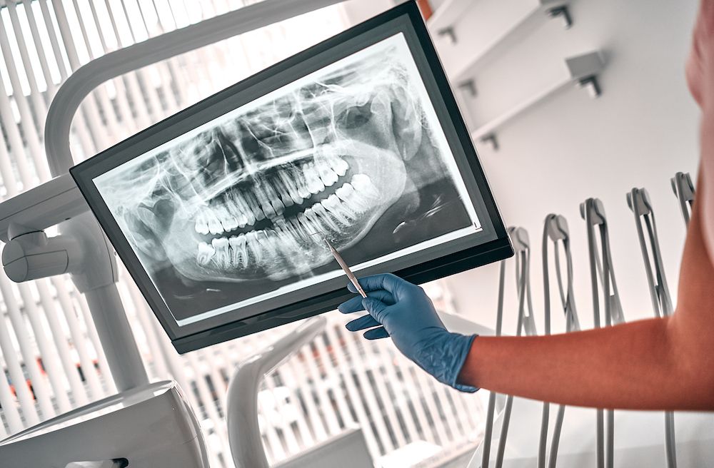 The Role of Dental X-rays in Diagnosing and Treatment Planning