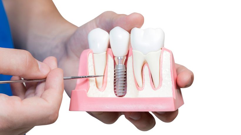 Dental Implants