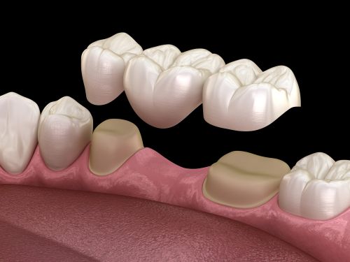 What Are Dental Bridges, and How Do They Work?