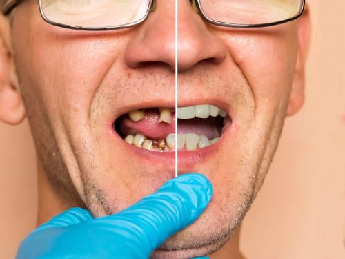 Dental Implants and Oral Health: How Implants Can Boost Overall Wellness