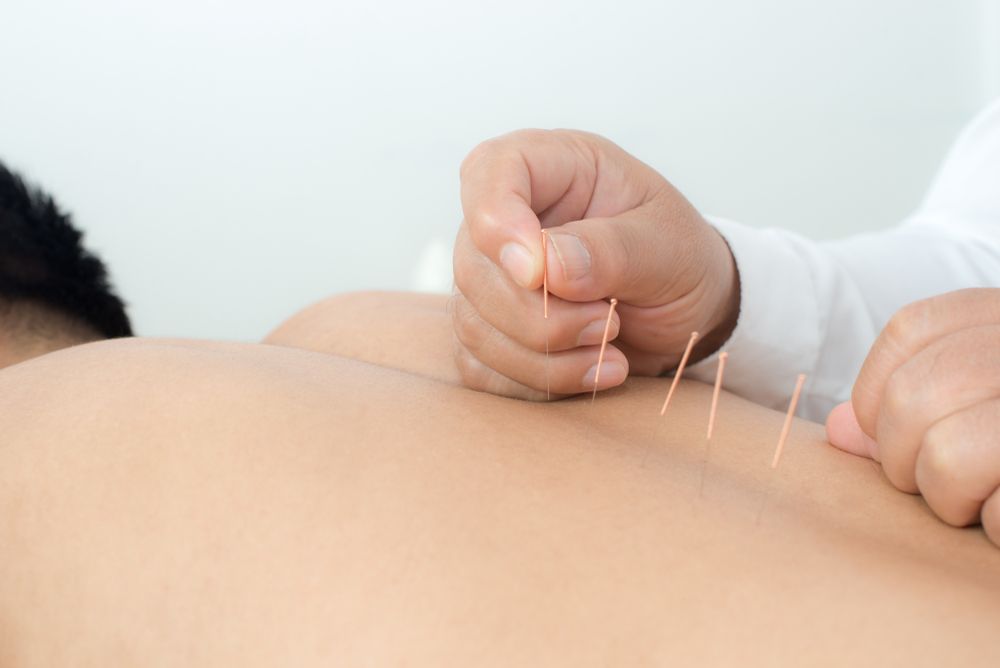 Discover the Benefits of Acupuncture for Chronic Pain: A Comprehensive Guide