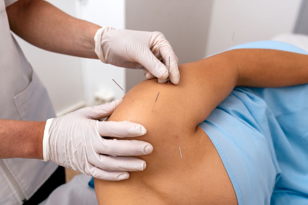 How Does Dry Needle Therapy Help With Chronic Pain and Mobility?