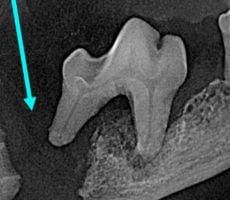 A Severe Result From Dental Disease