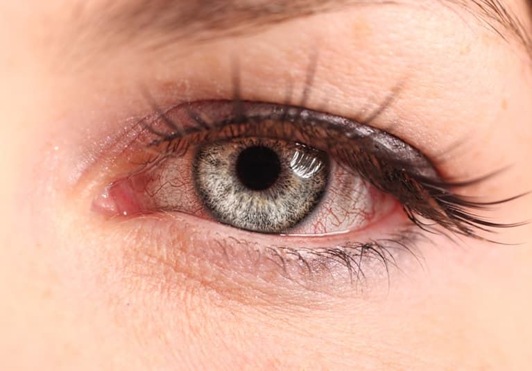 Everything You Need To Know About Pink Eye