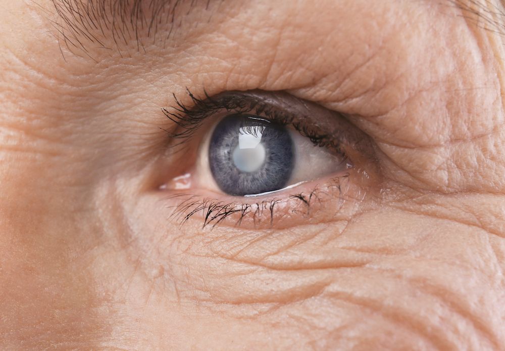 Who is Most at Risk of Getting Cataracts?