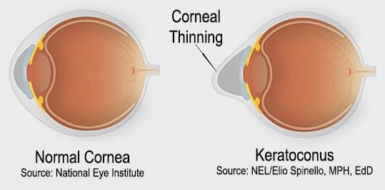 Keratoconus