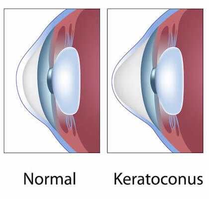 Keratoconus