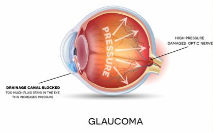 Glaucoma