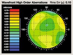 Keratoconus