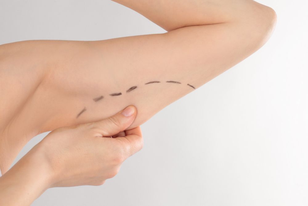 Am I a Candidate for Arm Lift Surgery?