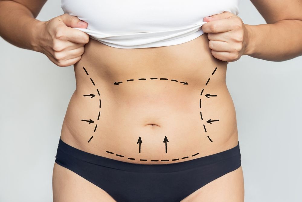 Tips to Maintain the Results From a Tummy Tuck