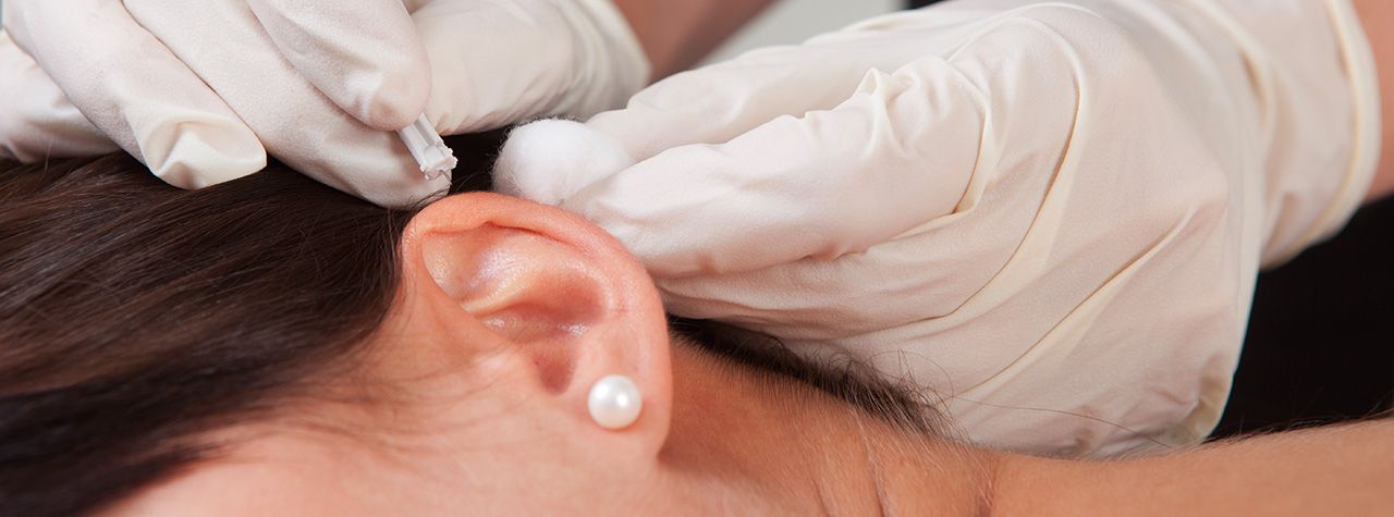 About Auricular Acupuncture
