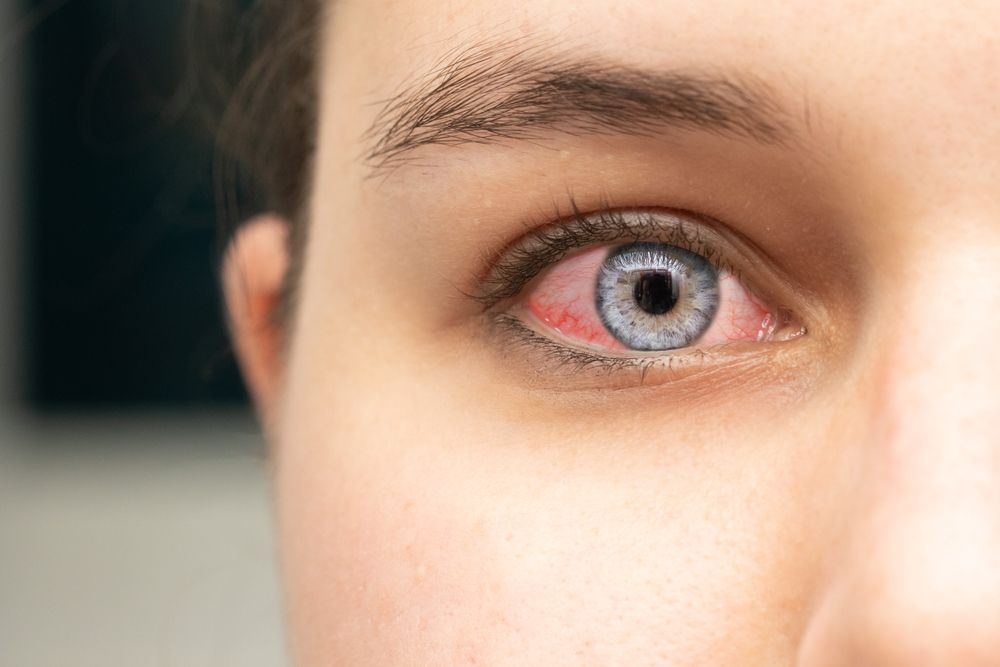 The Reasons Behind Red Eyes and How to Soothe Them