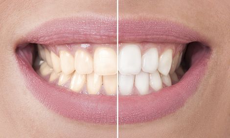 teeth whitening