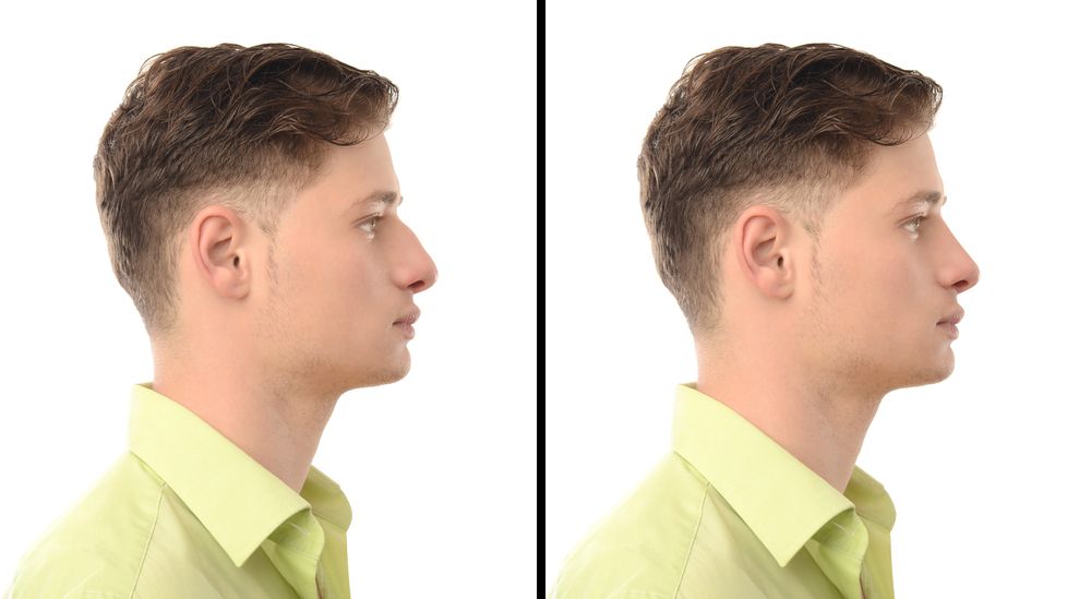 man before and after nose job