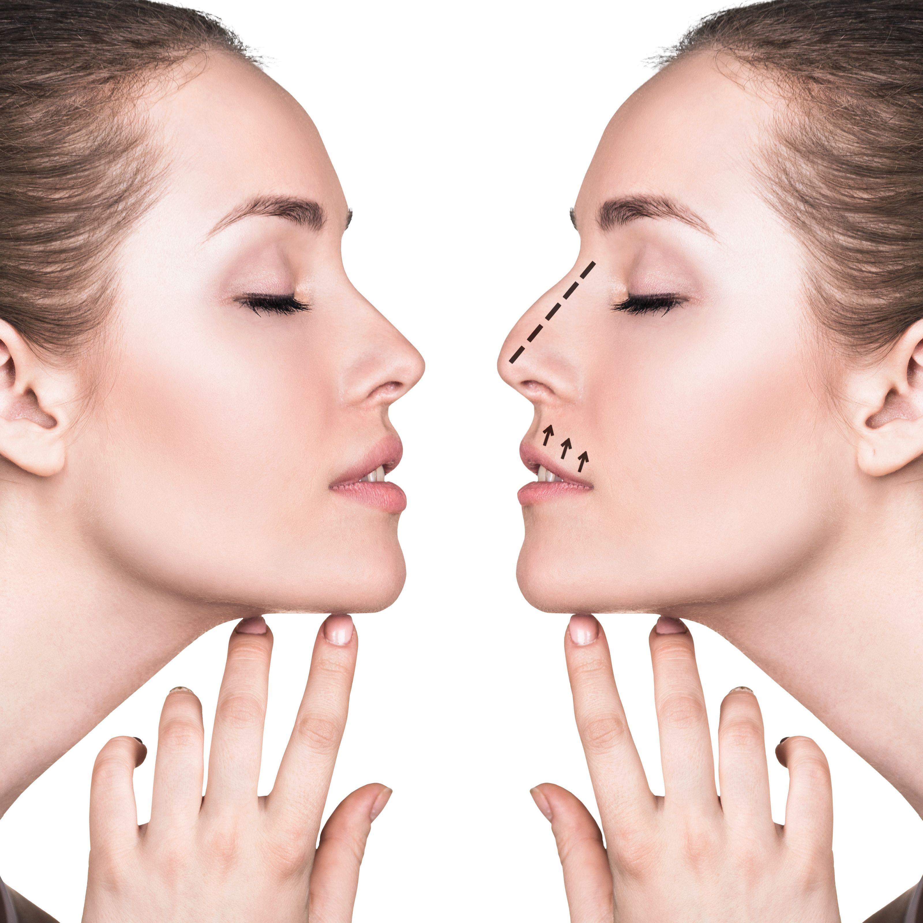 nose job
