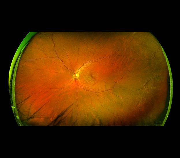 Ultra Wide Retinal Imaging