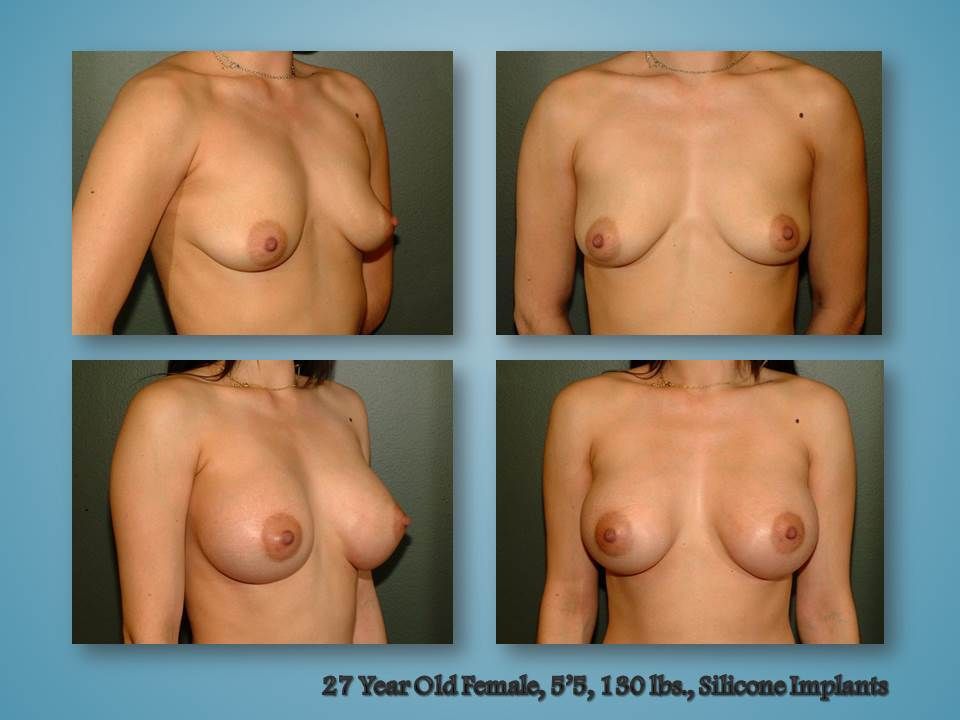 Before and after procedure in the Body