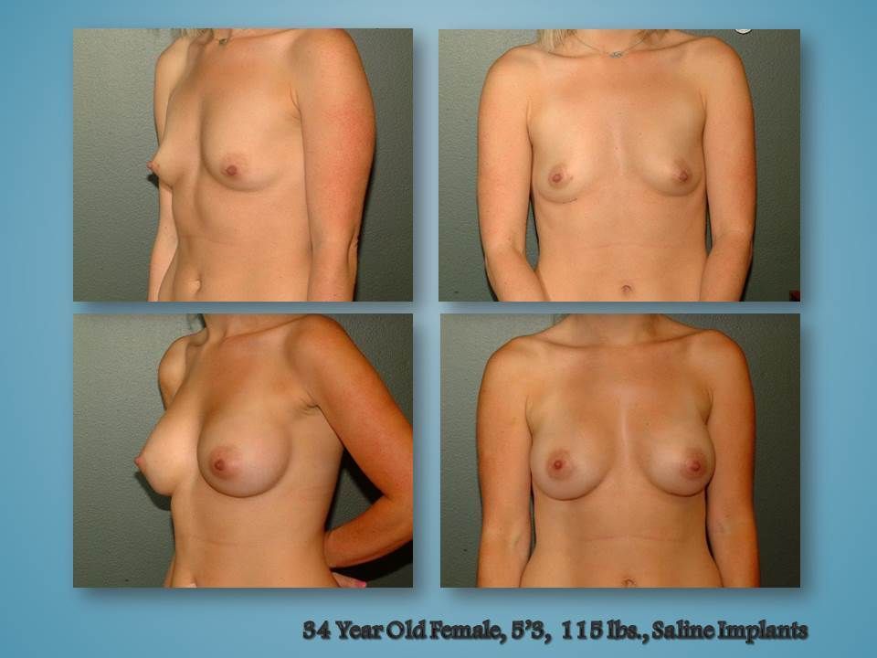 Before and after procedure in the Body