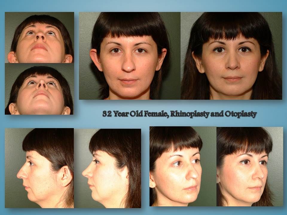 Before and after procedure in the Face