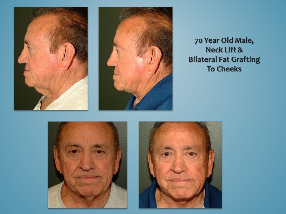 Before and after procedure in the face