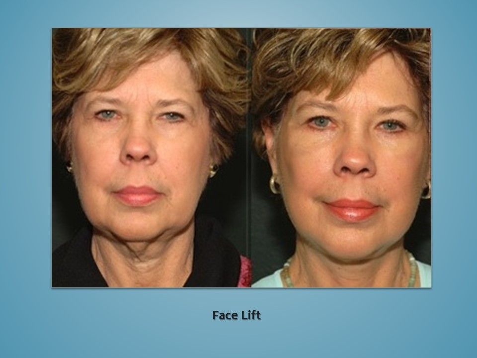 Before and after procedure in the face
