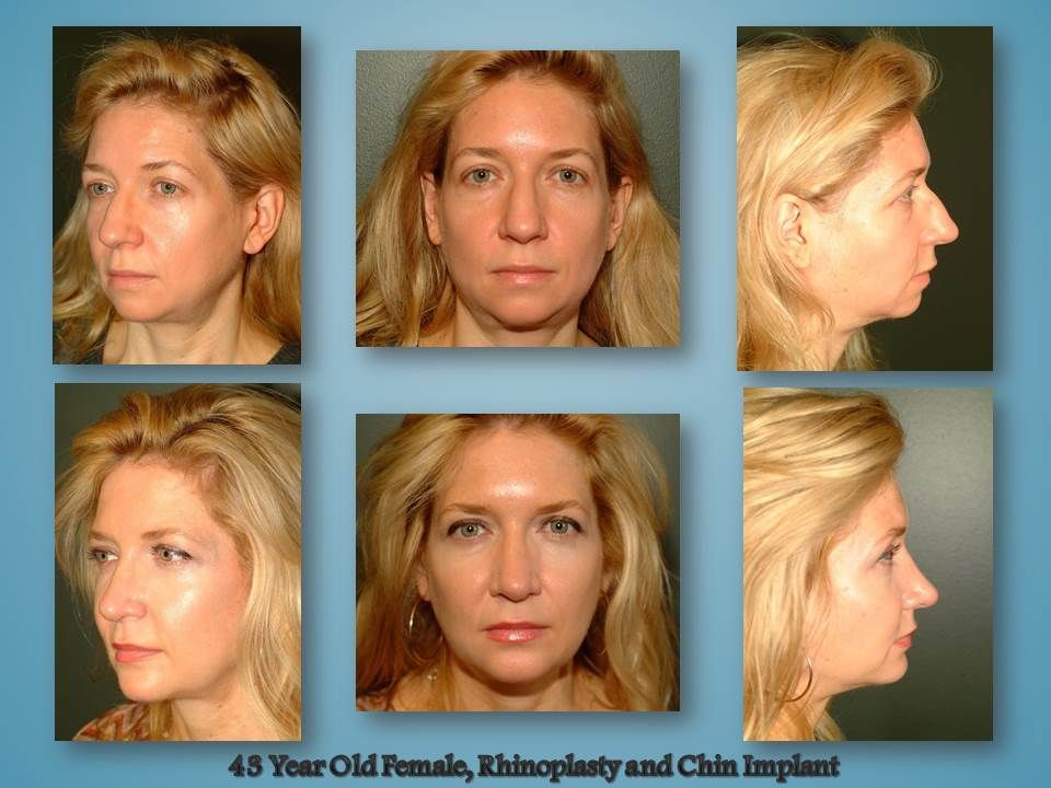 Before and after Rhinoplasty