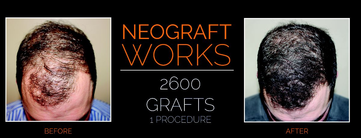 hair restoration neograft