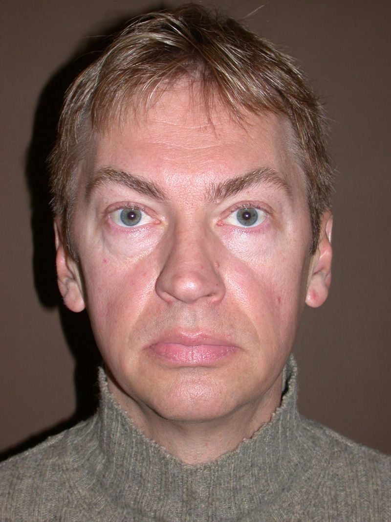 Before Nose Job Surgery by Dr. Bermudez in San Francisco