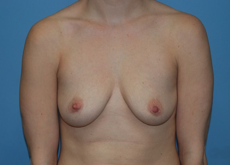 Before Breast Augmentation with Fat Grafting by Dr. Bermudez