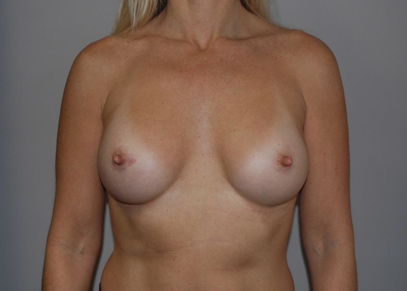 After Breast Augmentation with Breast Implants by Dr. Bermudez