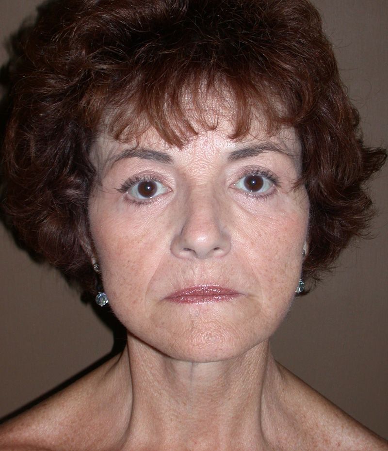 After Face Lift with Eyelid Surgery by Dr. Bermudez in San Francisco