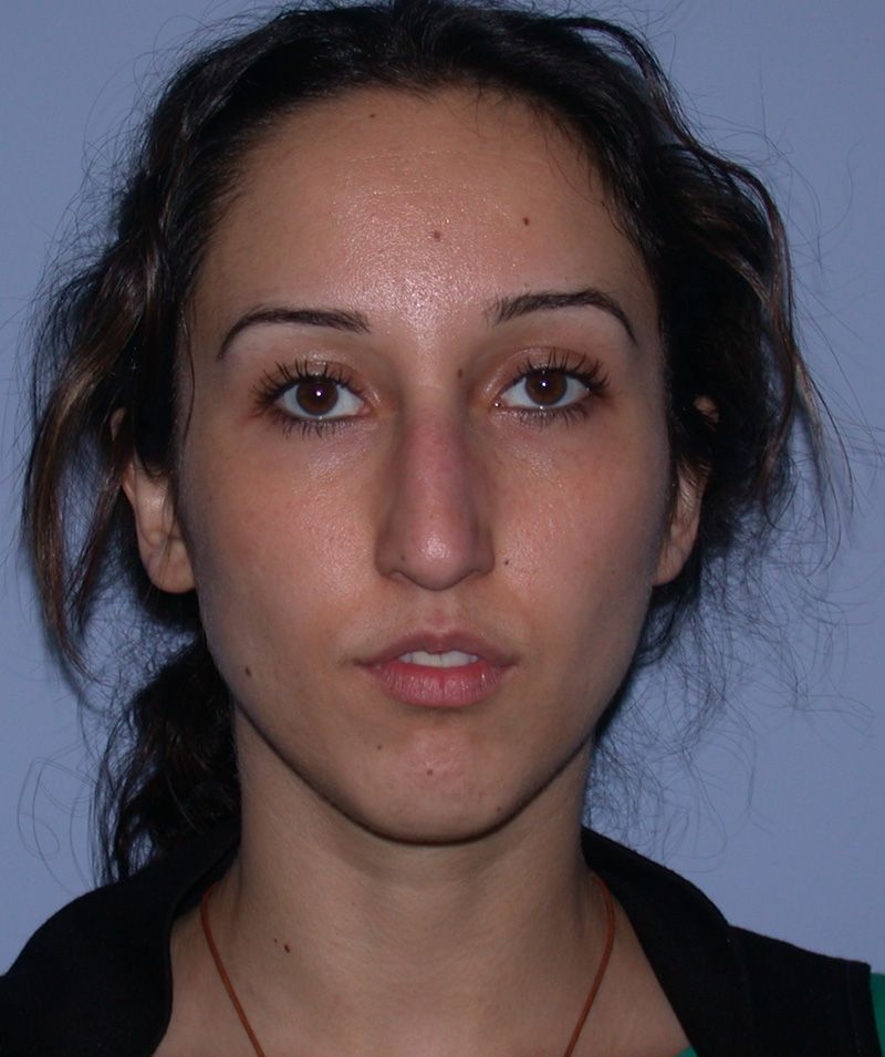 Before Nose Job Surgery by Dr. Bermudez in San Francisco