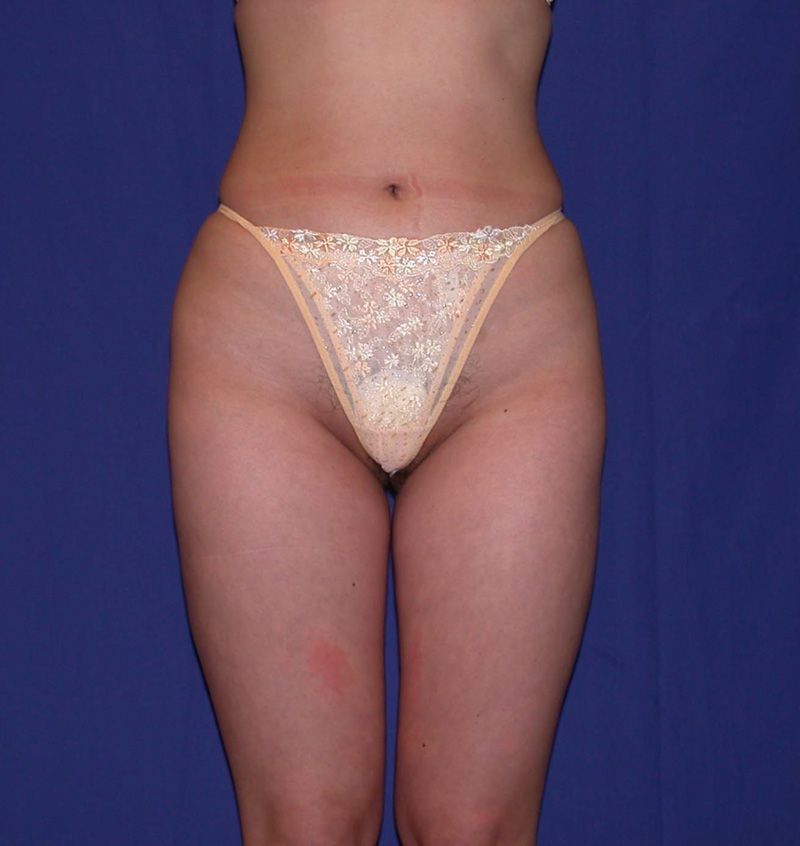 After Liposuction by Dr. Bermudez