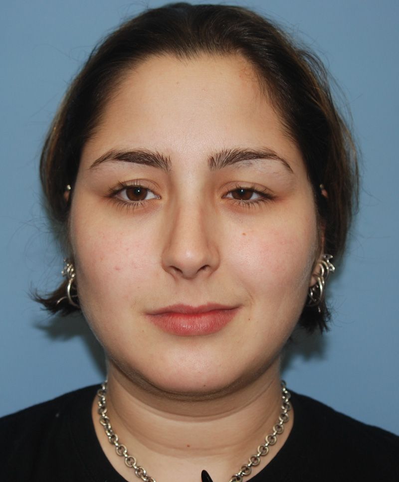 After Nose Job Surgery by Dr. Bermudez in San Francisco