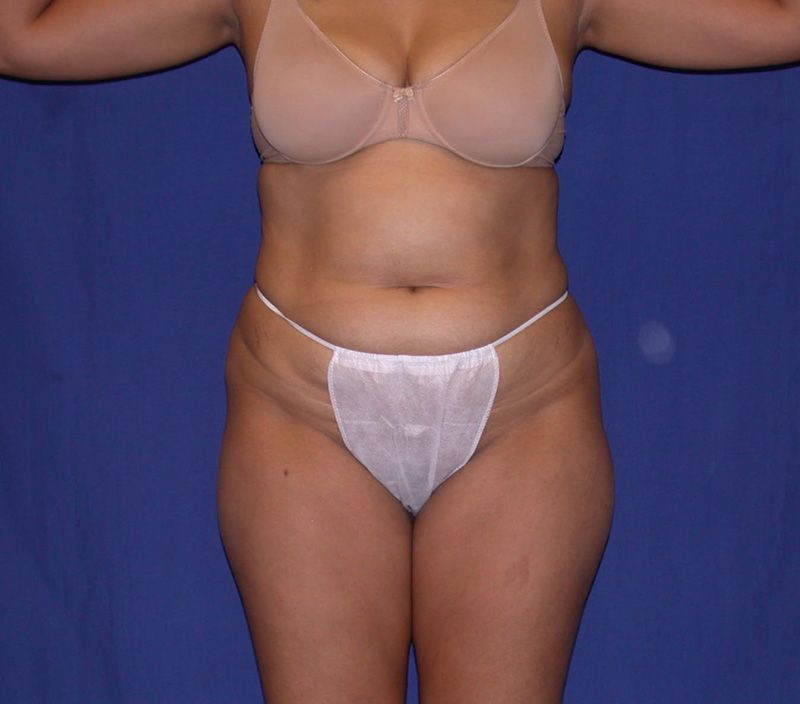 Before Abdominoplasty by Dr. Bermudez