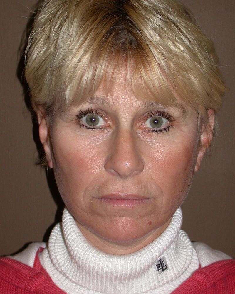 After Face Lift with Lip Filler by Dr. Bermudez in San Francisco